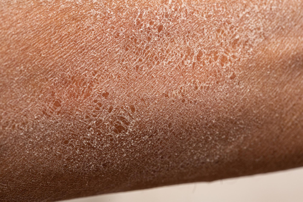 Cómo tratar la piel reseca y escamosa en las piernas